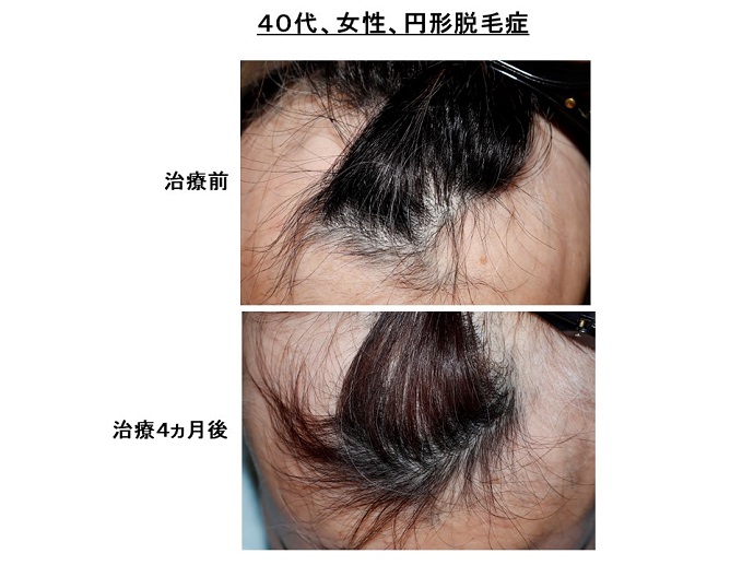 円形脱毛症　病院